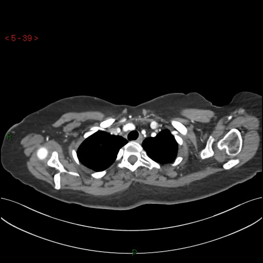 File:Aortic arch origin of left vertebral artery (Radiopaedia 51520-57286 A 38).jpg