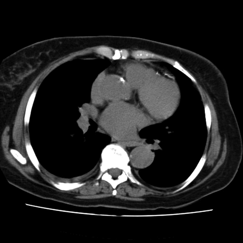 Aortic arch pseudoaneurysm (Radiopaedia 8534-9368 Axial non-contrast 42).jpg