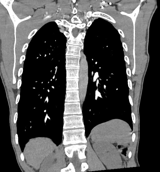 File:Aortic coarctation with aneurysm (Radiopaedia 74818-85828 C 85).jpg