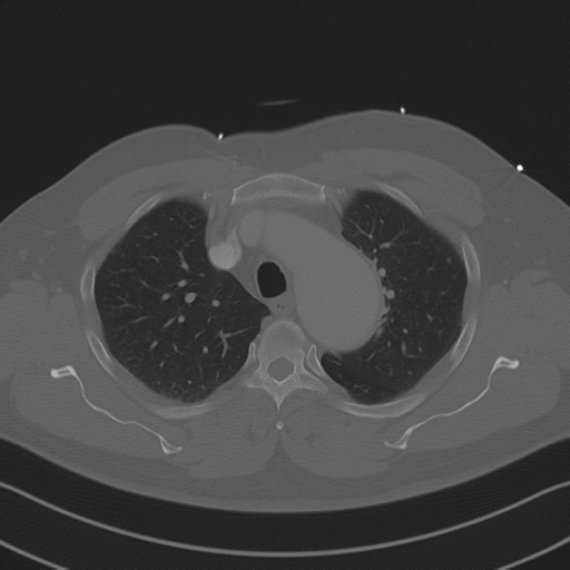 File:Aortic dissection (Radiopaedia 50763-56234 Axial bone window 33).png