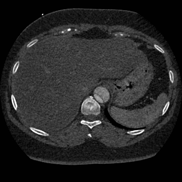 File:Aortic dissection (Radiopaedia 57969-64959 A 281).jpg