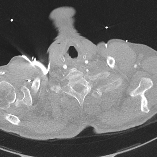 File:Aortic dissection - DeBakey type II (Radiopaedia 64302-73082 Axial lung window 3).png