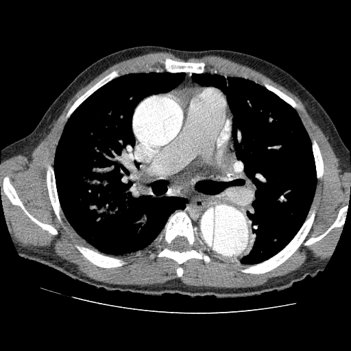 File:Aortic dissection - Stanford A -DeBakey I (Radiopaedia 28339-28587 B 39).jpg