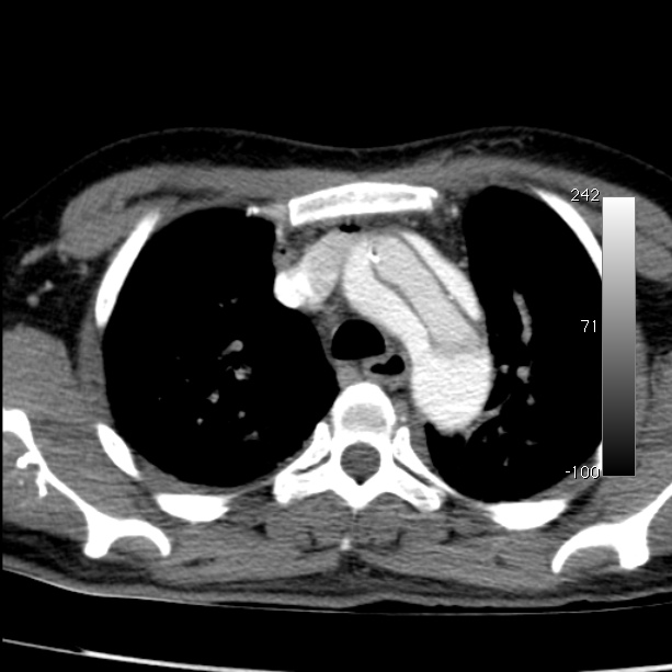 Aortic dissection - Stanford type A (Radiopaedia 29247-29659 A 21).jpg