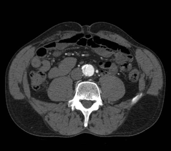 Aortic dissection - Stanford type B (Radiopaedia 73648-84437 A 189).jpg