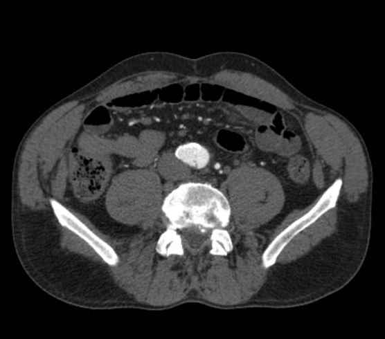 File:Aortic dissection - Stanford type B (Radiopaedia 73648-84437 A 195).jpg