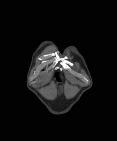 Aortic dissection - Stanford type B (Radiopaedia 73648-84437 B 2).jpg