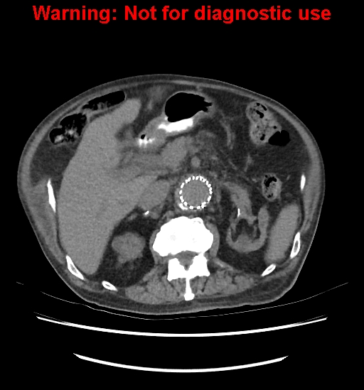 Aortic graft infection (Radiopaedia 44979-48907 Axial non-contrast 39).jpg