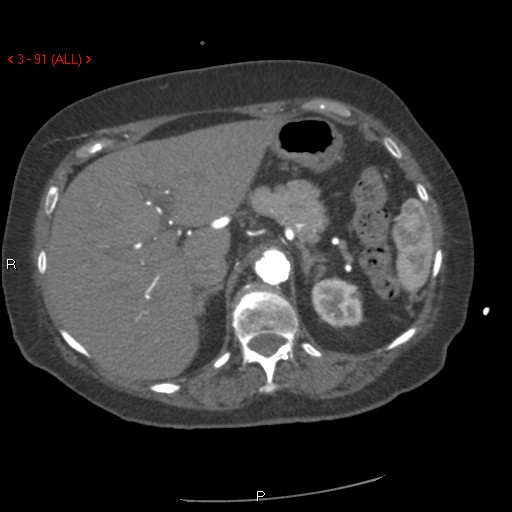 Aortic intramural hematoma (Radiopaedia 27746-28001 A 91).jpg