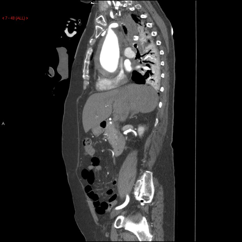 Aortic intramural hematoma (Radiopaedia 27746-28001 C 17).jpg