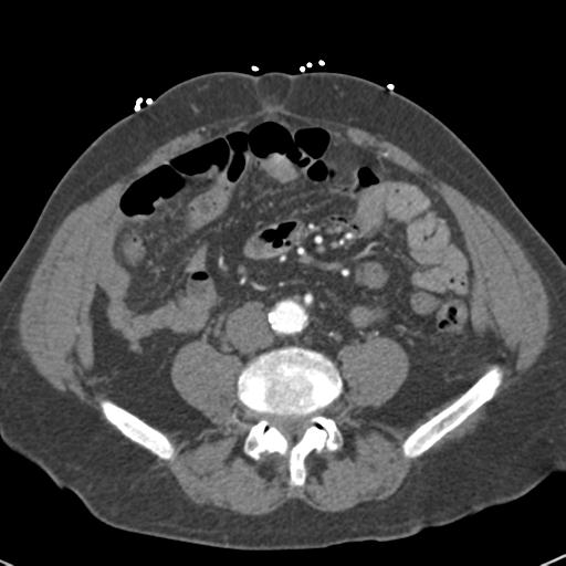 Aortic intramural hematoma (Radiopaedia 31139-31838 B 123).jpg