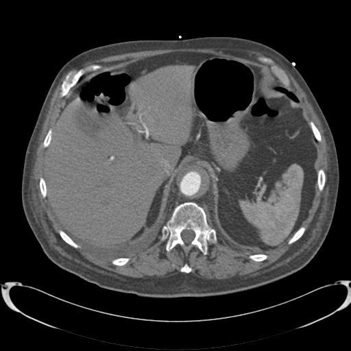 Aortic intramural hematoma (Radiopaedia 34260-35540 B 41).png