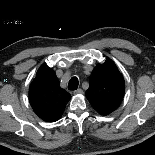 Aortic intramural hematoma (Radiopaedia 48463-53380 Axial non-contrast 30).jpg