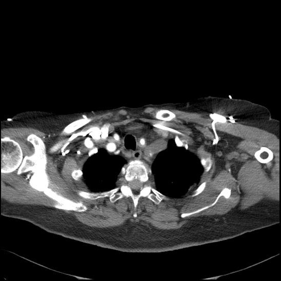 Aortic intramural hematoma with dissection and intramural blood pool (Radiopaedia 77373-89491 B 30).jpg
