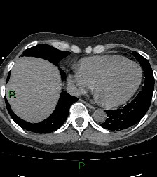 File:Aortic valve endocarditis (Radiopaedia 87209-103485 Axial non-contrast 74).jpg