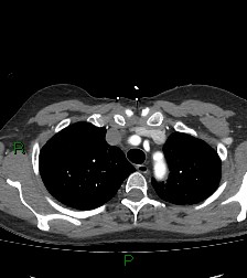 Aortic valve endocarditis (Radiopaedia 87209-103485 C 20).jpg