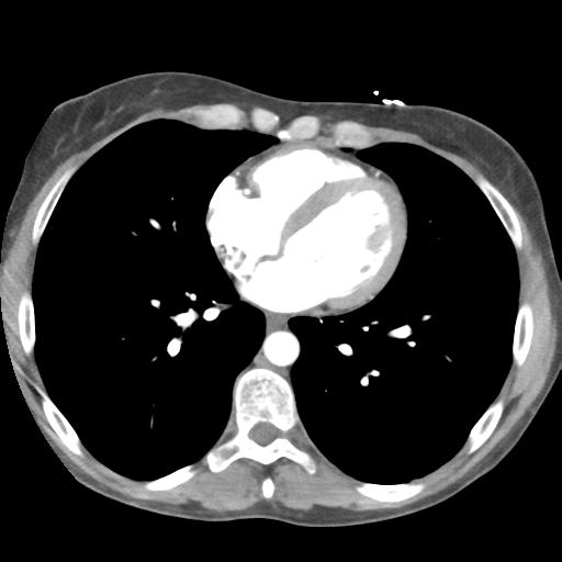 File:Aortic valve non-coronary cusp thrombus (Radiopaedia 55661-62189 B 32).png