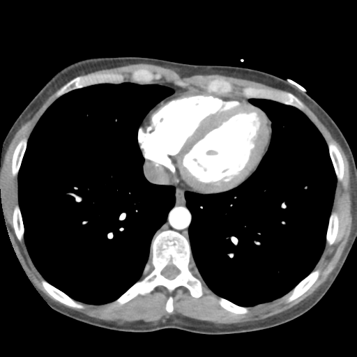 Aortic valve non-coronary cusp thrombus (Radiopaedia 55661-62189 B 36).png