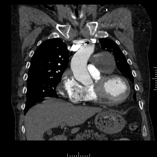 File:Aorto-coronary bypass graft aneurysms (Radiopaedia 40562-43157 B 15).png