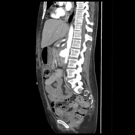 File:Aorto-duodenal fistula (Radiopaedia 25668-25850 C+ arterial phase 8).jpg