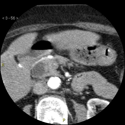 Aortoiliac occlusive disease (Radiopaedia 16828-16548 A 56).jpg