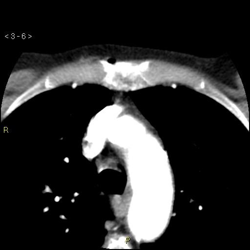 File:Aortoiliac occlusive disease (Radiopaedia 16828-16548 A 6).jpg