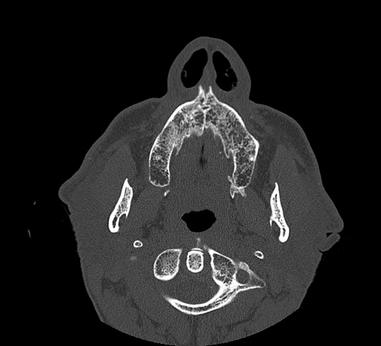 Aplastic maxillary sinuses (Radiopaedia 60030-67561 Axial non-contrast 10).jpg