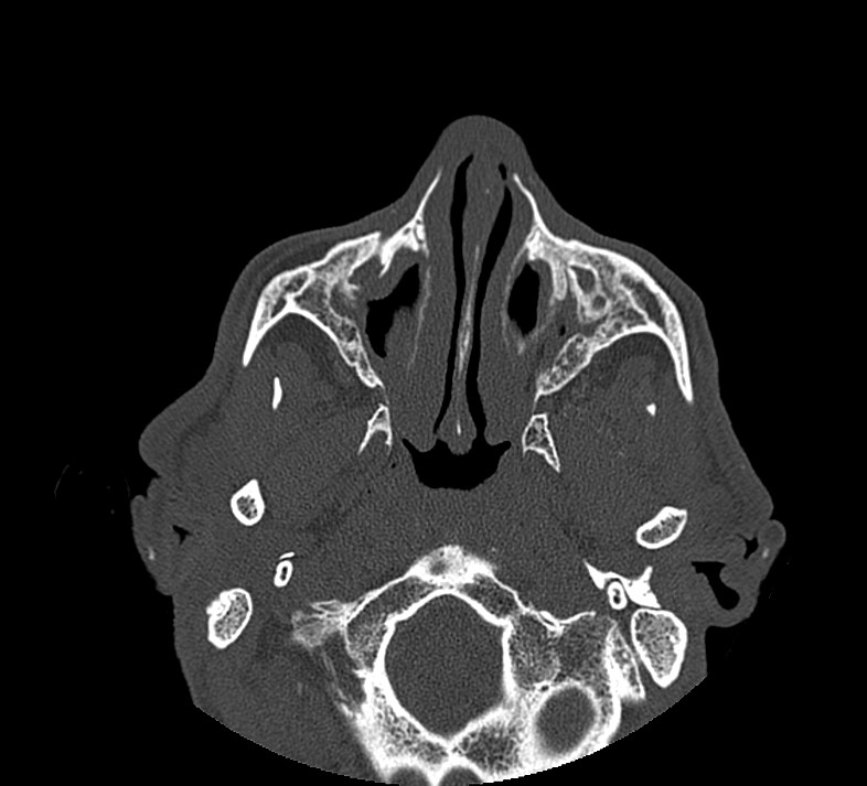 Aplastic maxillary sinuses (Radiopaedia 60030-67561 Axial non-contrast 27).jpg