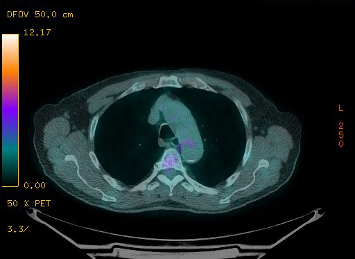 Appendiceal adenocarcinoma complicated by retroperitoneal abscess (Radiopaedia 58007-65041 Axial PET-CT 51).jpg