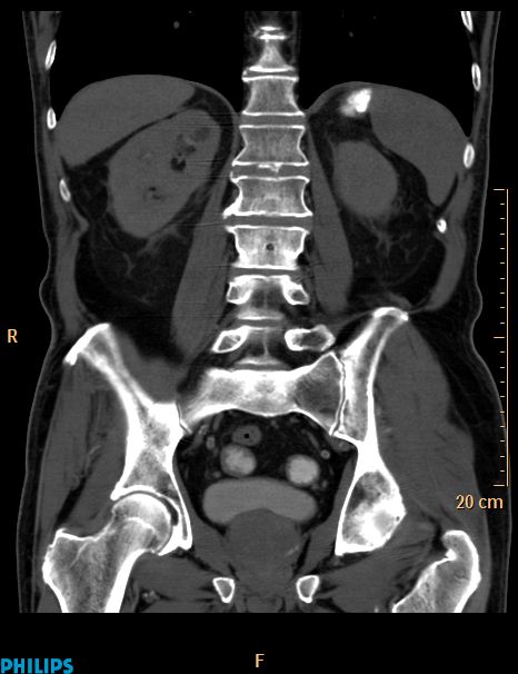 Appendiceal mucocoele (Radiopaedia 29449-29917 E 3).jpg