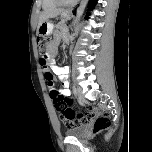 Appendicitis complicated by post-operative collection (Radiopaedia 35595-37114 C 43).jpg