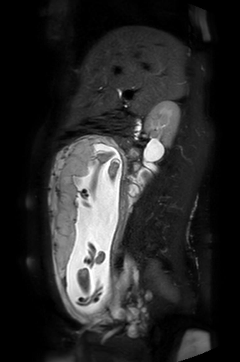 Appendicitis in gravida (MRI) (Radiopaedia 89433-106395 Sagittal T2 SPAIR 39).jpg