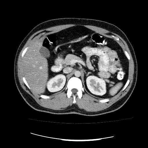 File:Appendicitis with diverticulosis (Radiopaedia 47693-52383 Axial C+ 44).jpg
