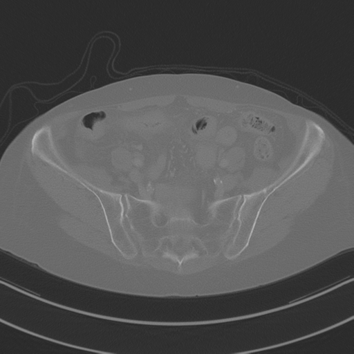 April fools' 2019- calcified peritoneal arachnoidosis (Radiopaedia 67273-76636 Axial bone window 38).png