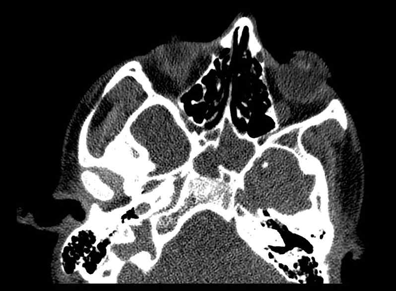 File:Arachnoid cyst- extremely large (Radiopaedia 68741-78450 Axial bone window 8).jpg