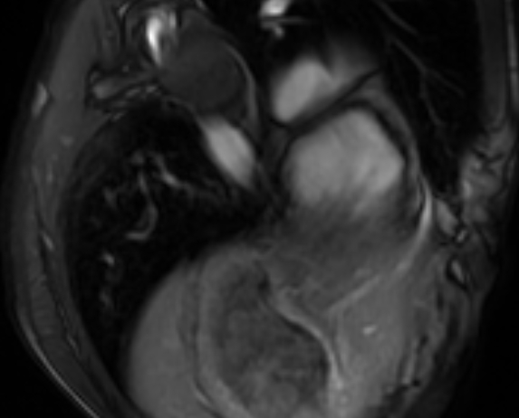 Arrhythmogenic right ventricular cardiomyopathy (Radiopaedia 69564-79464 4ch cine 148).jpg