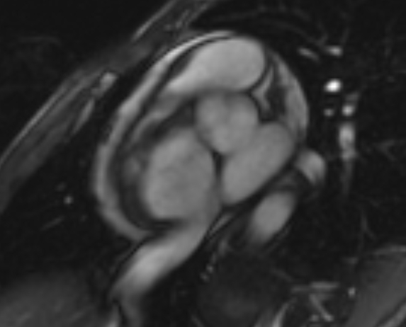 Arrhythmogenic right ventricular cardiomyopathy (Radiopaedia 69564-79464 short axis cine 248).jpg
