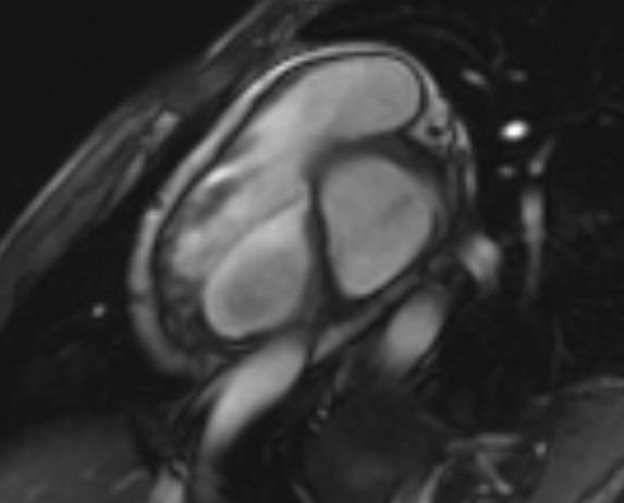 Arrhythmogenic right ventricular cardiomyopathy (Radiopaedia 69564-79464 short axis cine 254).jpg