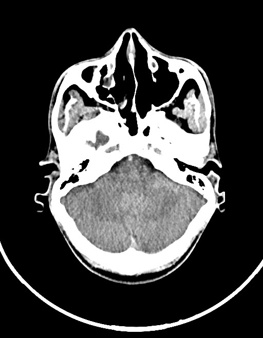 Arrow injury to the brain (Radiopaedia 72101-82607 Axial non-contrast 57).jpg