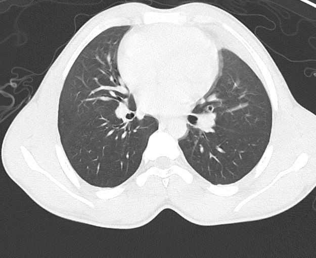 Arrow injury to the chest (Radiopaedia 75223-86321 Axial lung window 41).jpg