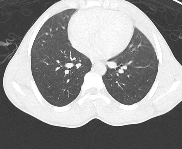 Arrow injury to the chest (Radiopaedia 75223-86321 Axial lung window 53).jpg