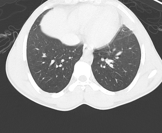 File:Arrow injury to the chest (Radiopaedia 75223-86321 Axial lung window 63).jpg