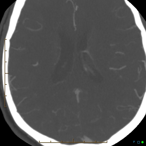 File:Artifactual basilar artery stenosis due to metallic stent (Radiopaedia 31206-31923 A 28).jpg