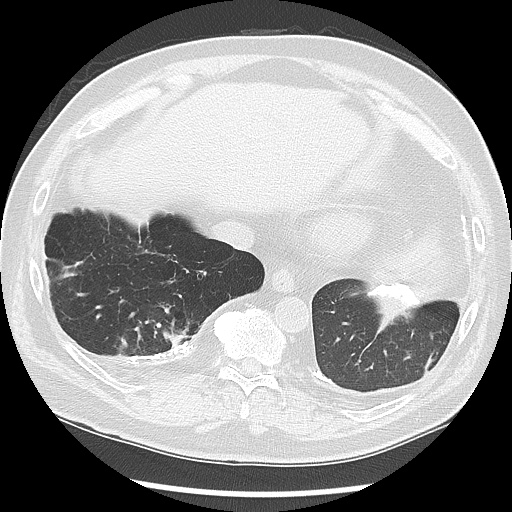 Asbestos-related pleural disease (Radiopaedia 74366-85250 Axial lung window 92).jpg