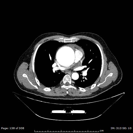 Ascending aortic aneurysm (Radiopaedia 50086-55404 A 37).jpg