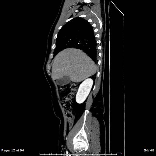 Ascending aortic aneurysm (Radiopaedia 50086-55404 C 11).jpg