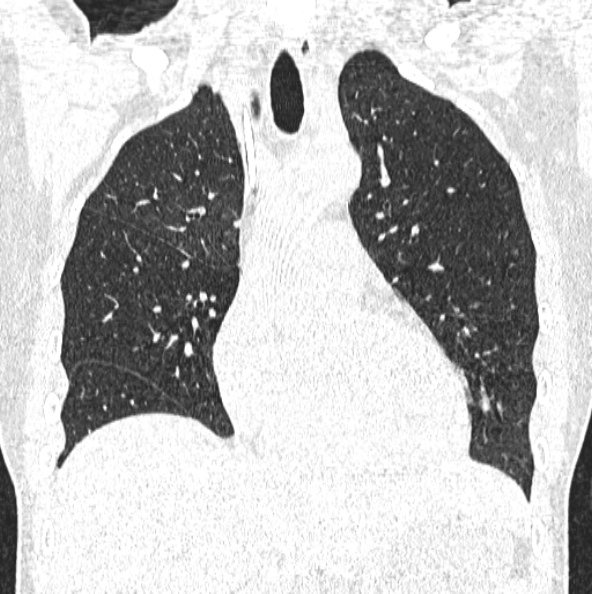 File:Aspergilloma (Radiopaedia 26223-26347 Coronal lung window 19).jpg
