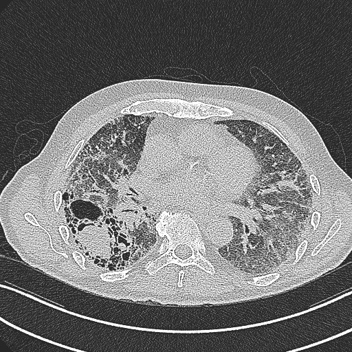 File:Aspergilloma on background pulmonary fibrosis (Radiopaedia 60942-68757 B 30).jpg