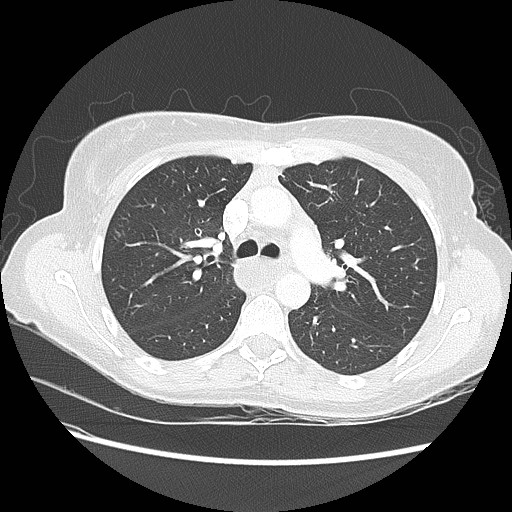 File:Aspiration pneumonia secondary to laparoscopic banding (Radiopaedia 18345-18183 lung window 38).jpg