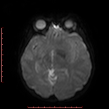 Astroblastoma (Radiopaedia 74287-85162 Axial DWI 41).jpg